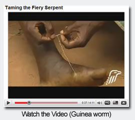 Watch the Video (Guinea worm)